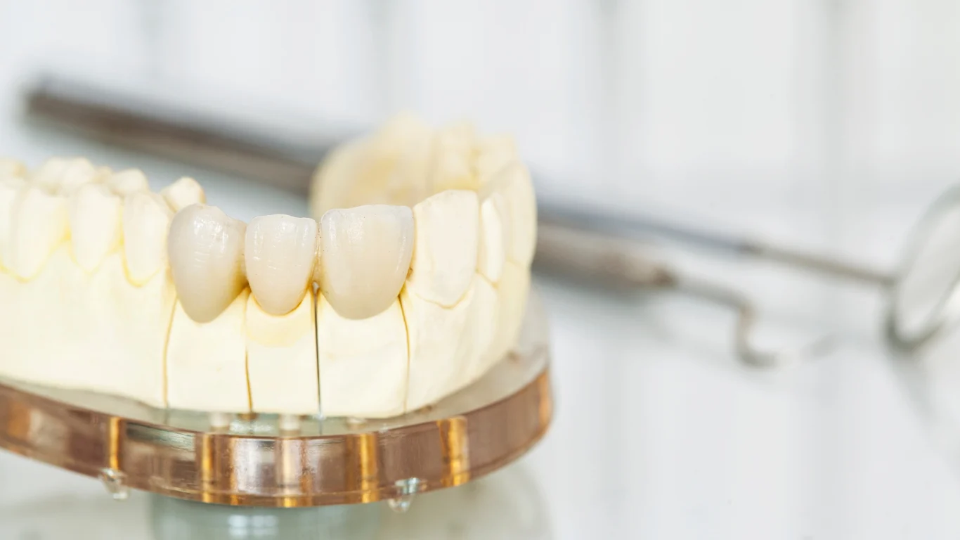 Tooth fillings (aka tampalan gigi) done by friendly and professional Dr Ching at Klinik Pergigian Dr Ching, Rawang. 