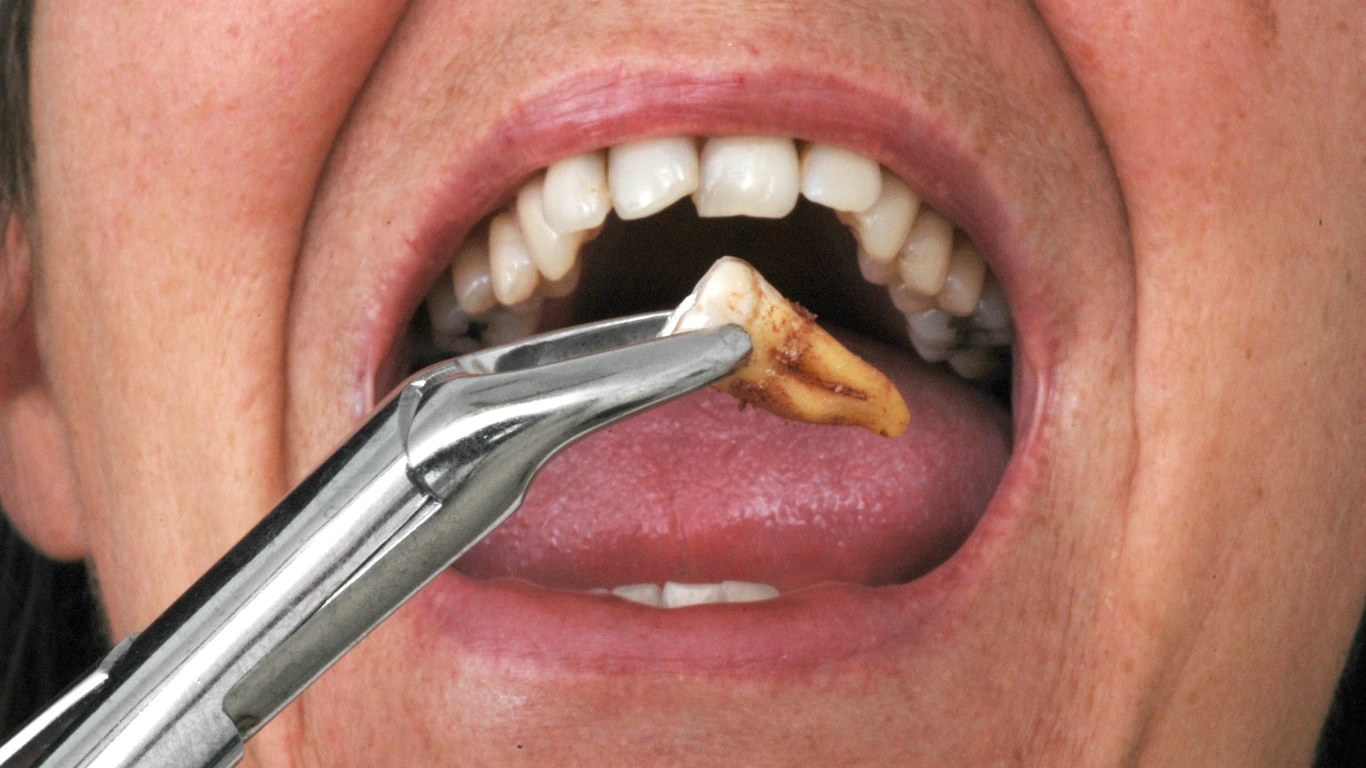 expert tooth extraction in (cabut gigi) rawang at dr Ching dental clinic located at anggun city, rawang.