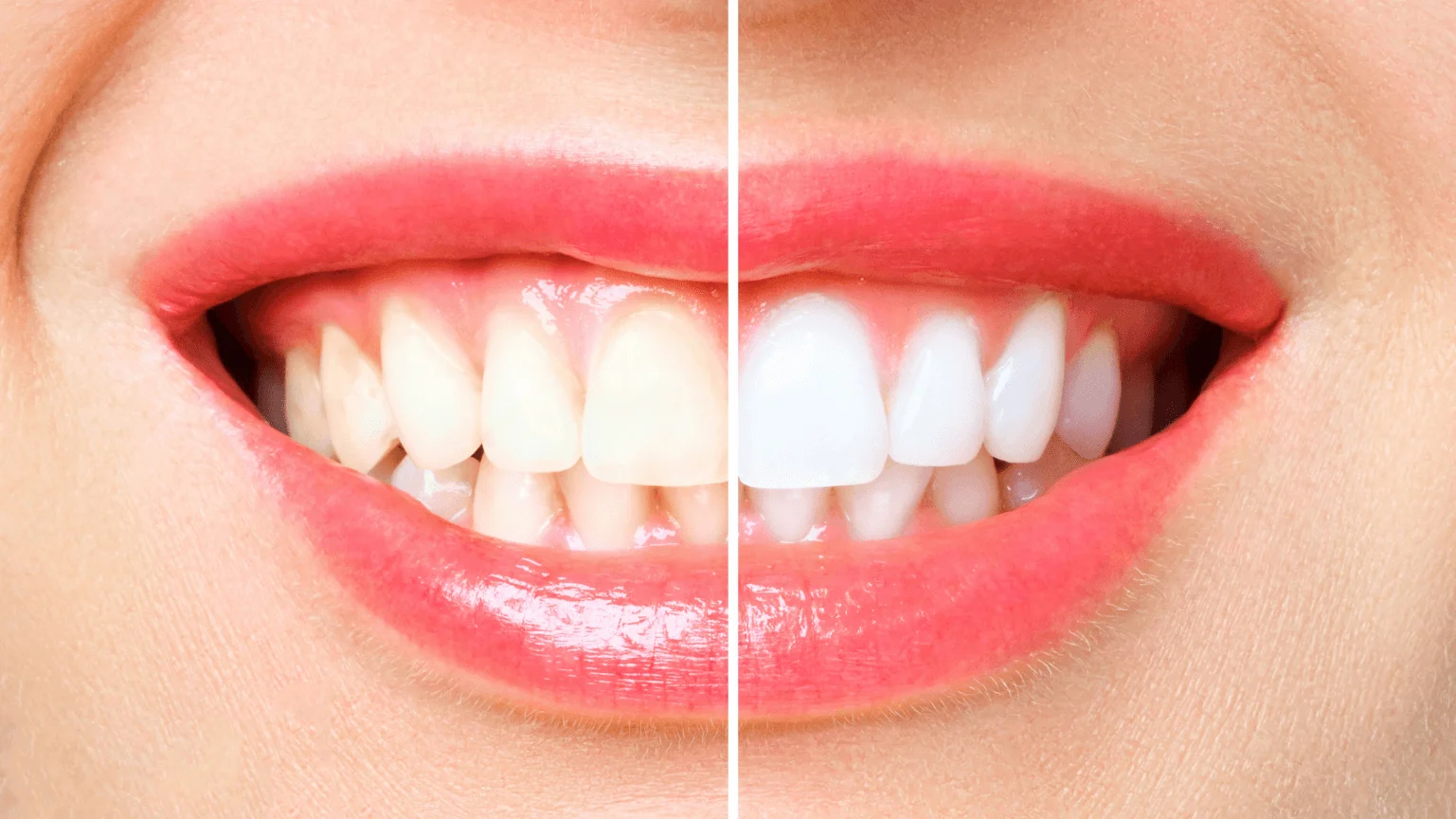 affordable teeth whitening in rawang at Klinik Pergigian Dr Ching